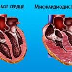 Myocardial dystrophy