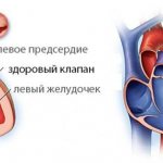Mitral stenosis 1.jpg