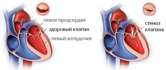 Митральный стеноз 1.jpg