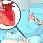 Mitral stenosis: causes and consequences of the disease