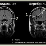 MRI of brain cyst