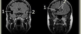 MRI of brain cyst