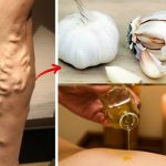 Наивная вера в лечение варикоза народными средствами