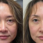 slight swelling of the face