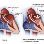 Mitral valve insufficiency (mitral regurgitation)