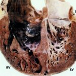 Non-compact ventricular myocardium