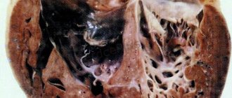 Non-compact ventricular myocardium