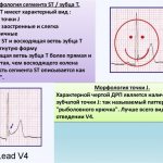 Nonspecific ST-T changes on the ECG. What is it in an adult, a child, during pregnancy, how to treat it 
