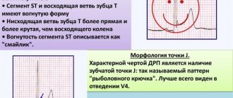 Неспецифические изменения ST-T на ЭКГ. Что это у взрослого, ребенка, при беременности, как лечить