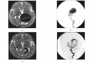 Аневризма галена. Артериовенозная мальформация вены Галена. Мальформация вены Галена мрт.