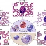 Immature granulocytes are increased in an adult: causes, norm in women, men