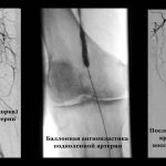 Obliterating atherosclerosis of the arteries of the lower extremities 10.jpg