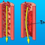 Blood clot formation