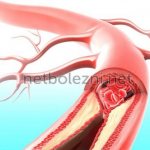 Formation of blood clots in veins