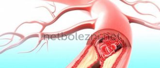 Formation of blood clots in veins