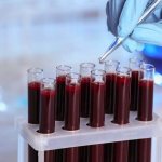 Онкомаркеры для выявления опухоли