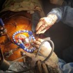 Heart surgeries at SOROKA MC