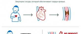 описание острого коронарного синдрома