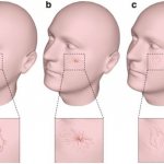 The main types of telangiectasia: a - tree-like, b - arachnid, c - linear