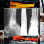 Features of thrombus recanalization