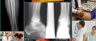 Особенности осуществления реканализации тромба