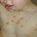 Acute lymphoblastic leukemia