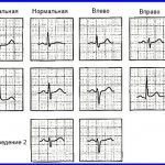 Отклонение электрической оси сердца влево