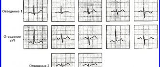 Deviation of the electrical axis of the heart to the left