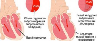 Пациент с низкой фракцией выброса левого желудочка