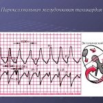 Paroxysmal tacicardia