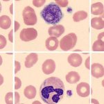 Pelger-Huet anomaly: a cause for concern or an accidental finding?