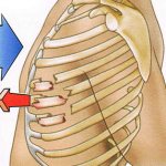 Перелом ребер