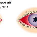 Перендний и задний увеит глаза