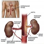 renal hypertension