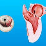 Why does reverse blood flow into the MV occur?