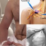 Почему возникает тромбоз подключичной вены