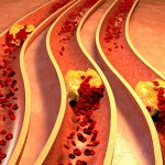 Indications for the use of stents