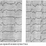 Complete right bundle branch block