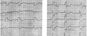 Complete right bundle branch block