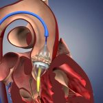 Aortic valve disease: features of its course and treatment