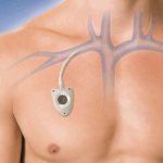 Chemotherapy port system