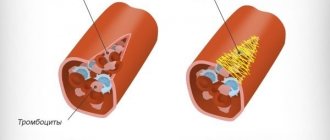 Elevated platelets in the blood of women. Causes and treatment, what does it mean