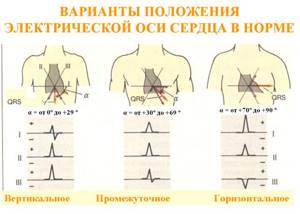 Вертикальное положение ЭОС: что это значит и чем опасно?