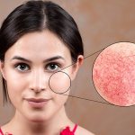 Causes of rosacea on the face