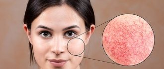 Причины появления купероза на лице