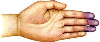 causes signs symptoms diagnosis and treatment - Cyanosis causes, signs, symptoms, diagnosis and treatment