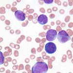 Причины развития неходжкинских лимфом