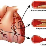 Causes of narrowing of the lumen of the coronary vessels