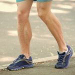 causes of varicose veins