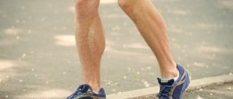causes of varicose veins